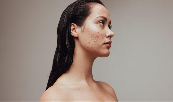 Best Skincare Products for Clogged Pores