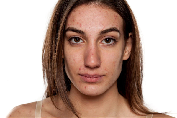Sulfur for Clogged Pores: Does It Really Work?
